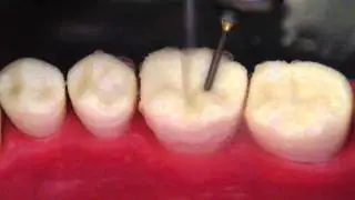 2 depth orientation occlusal