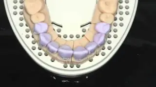 Cerec multiple unit anterior