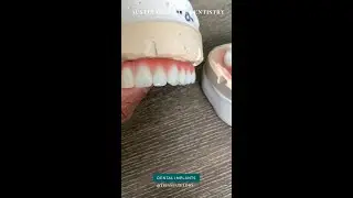Austin Dental Implant Treatment  (512) 476-2336