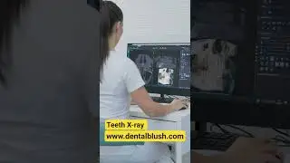 How Dental X-Rays Detect Hidden Tooth Problems || #teethcleaning #dentalblush