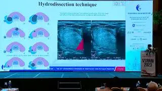 Update techniques and tips of Radiofrequency ablation for treating benign and malignant thyroid ...