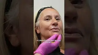 A full face transformation? Look at what Anti-Wrinkle & Filler treatments can do 😍