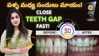 Simple Teeth Gap Treatment Options by Dr. Swetha in Telugu | Platina Dental