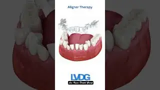 How Invisalign Works: Clear Aligner Therapy Las Vegas Dental Group | Aligners Dentist #aligners