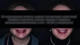 Виниринг в Шымкенте| стоматология Dental Expert