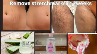 Stretch marks removal how to get rid of-stretch marks in two weeks easy homemade recipes#stretchmark