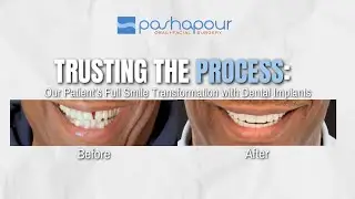 Trusting the Process: Our Patient&rsquo;s Full Smile Transformation with Dental Implants