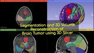 Segmentation and 3d Volume Reconstruction of Brain Tumor using 3d Slicer
