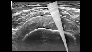 A hidden pain generator - Shoulder case study