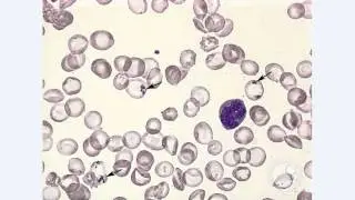 inclusion bodies    pappenheimer bodies