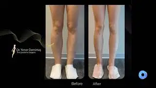 Part 3 &ndash; Before & After, Dr. Yener Demirtaş, The Lipedema Surgeon