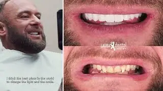 How to Achieve a Hollywood Smile?
