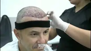 Sapphire FUE Hair Transplant in Turkey with Dr. Ekrem Keskin 💎