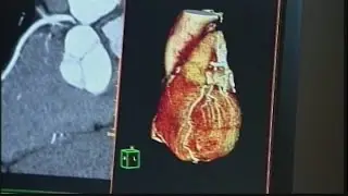 New calculator for heart disease risk