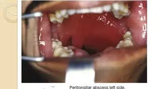 quinsy and parapharyngeal abscess