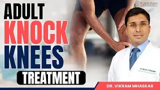 Knock Knees in Adults Treatment और Recovery Guide | Knock Knee Problem Solution | Dr.Vikram Mhaskar