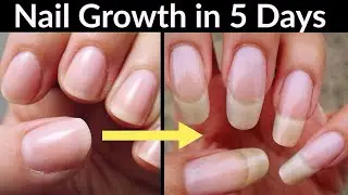 Nail Growth Supplements, Home Remedies, How to grow long strong nails fast at home Urdu Hindi