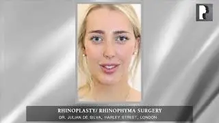 Rhinoplasty/ Rhinophyma Surgery Before-After