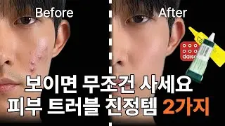 광고❌ 여드름 10년차가 강력 추천하는 다이소 단돈 3천원 제품