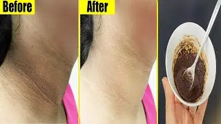 Get Rid Of Dark Neck In 20 Minutes.