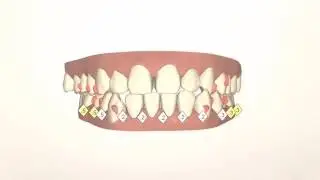 Patient 144 Invisalign Movie