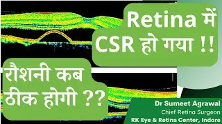 CSR (RETINA में SWELLING) हो गया ? अब नज़र कब ठीक होगी ?
