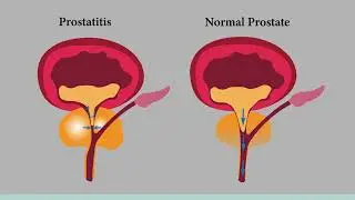 PROSTATE ENLARGEMENT SURGERY EXPLAINED - Types & Recovery Process