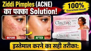 Clincitop Gel | Clincitop cream use hindi | clincitop cream | clincitop clindamycin acne pimples
