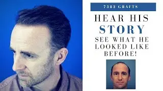 Hair Transplant | 7382 Grafts Hairline, Frontal Zone & Mid Scalp