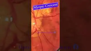 Myopic Crescent | Fundus Photography | Myopic Fundus | Short Video 239  #viral #optometryacademy