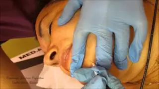 DEPILACIÓN ELÉCTRICA