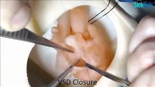 HOST - TOF Repair (Transannular patch) on a 3D-printed model - Dr Christoph Haller