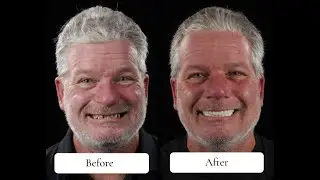 Dental Implant Full Mouth Transformation That Changed Everything