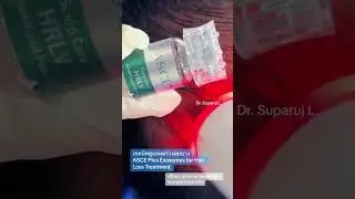 เทคนิครักษาผมร่วงผมบาง ด้วย ASCE Plus HRLV Exosomes for Hair Loss Treatment