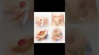 colostomy #shortvideo #bscnursing #nursingvideo #viralvideo #trendingshorts