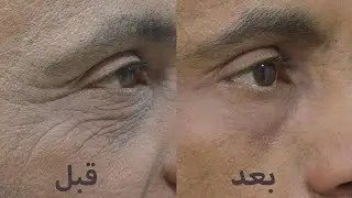 علاج الخطوط حول العين
