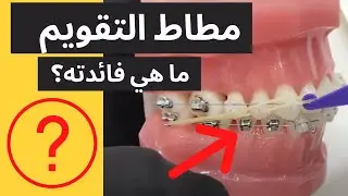 طريقة استخدام المطاط المنزلي  مع تقويم الاسنان