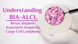 Putting Breast Implant-Associated ALCL Into Perspective