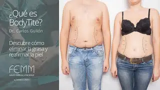 ¿Qué es BodyTite? La tecnología que revoluciona la liposucción