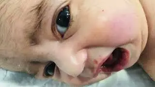 Critical Baby with Bronchiolitis & Birth Complications | Please Pray for Recovery