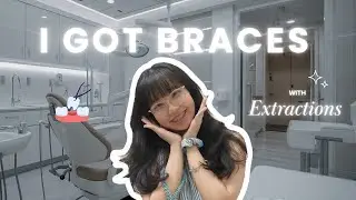 I Got Braces (With Extractions) | Before, During & After