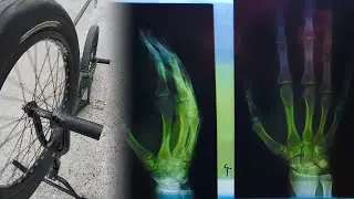 Сломал палец с BARSPIN на BMX и купил себе пеги CULT Butter Light Nylon BMX