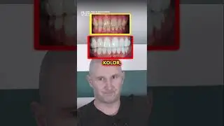 NATURALNY KSZTAŁT CZY PRZEROŚNIĘTY? 🦷🔍 Dentysta: PO CZYM POZNASZ, ŻE BONDING JEST PRZESADZONY!