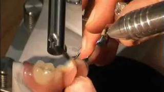 Primotec phaser dental welder welding a broken lingual bar with Joker welding assistant