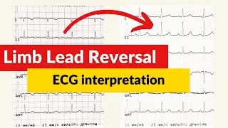 Limb Lead Reversal ECG. ECG/EKG interpretation.