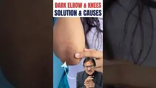 Elbows & Knees  Turning Black? | Causes, Treatment & What to Avoid #skincare #darkskin #shorts