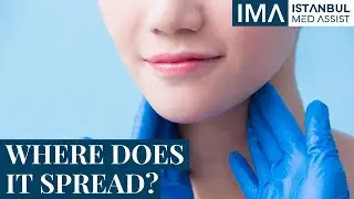 Where Does Salivary Gland Cancer Spread to? - Otolaryngology