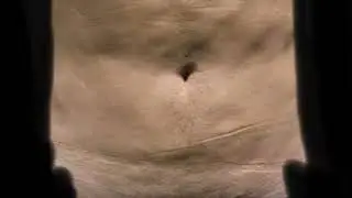 Bbl, Liposuction, Fat Transfer, AdamJ Rubinstein, BOTCHED. Poor Technique$ Bad Skills