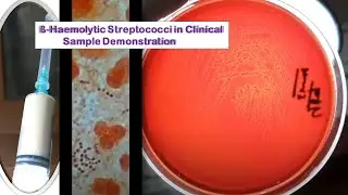 Streptococcus pyogenes in Pus Culture Demonstration