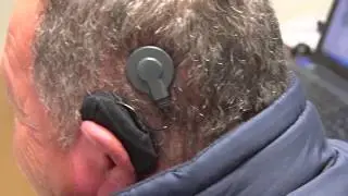 Avances en implantes cocleares